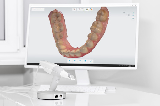 Bild von einem Intraoral 3D-Scanner