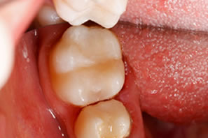 Zähne, Füllung nachher