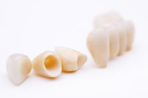 Beispiel einer Zahnprothese